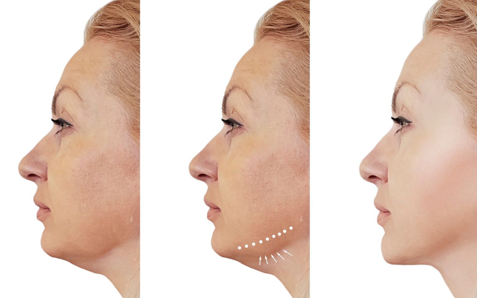 Best Non-Surgical Facelift for Jowls: Minimally Invasive Options